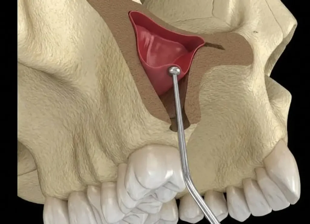 הדמיה של ניתוח הרמסת סינוס במרפאת One Dental