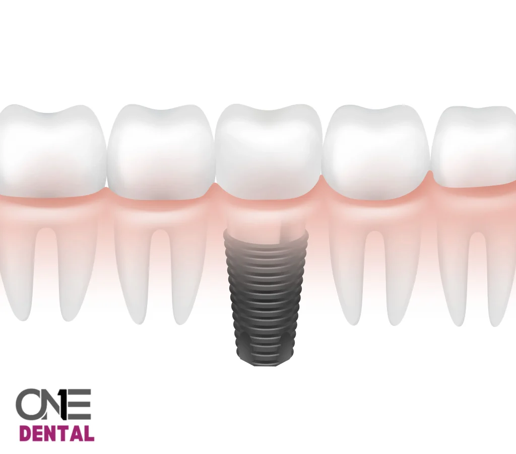 השתלת שן במרפאת שיניים One Dental
